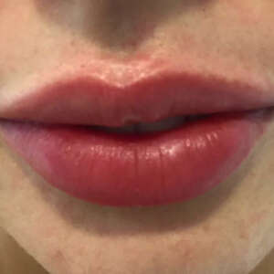 Natürlich geformte Lippen mit Hyaluron nachher