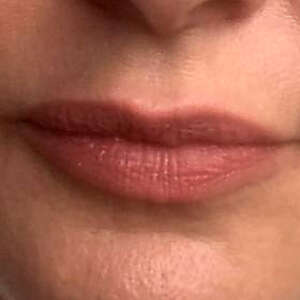 Korrektur von asymetrischen Lippen nachher