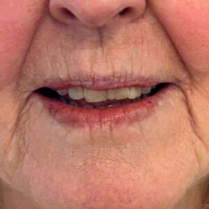 Lippenformung Plisseefältchenaufhebung Marrionettenfaltenkorrektur vorher
