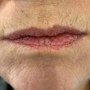 Hyaluronbehandlung Lippen vorher