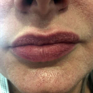 Korrektur von asymetrischen Lippen vorher