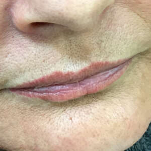 Korrektur von natürlichen asymetrischen Lippen mit Permanent Make Up und Hyaluron vorher