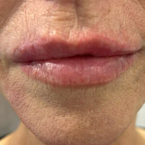 Lippenkorrektur mit Narbenbildung nachher