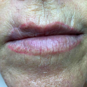 Lippenkorrektur mit Narbenbildung vorher