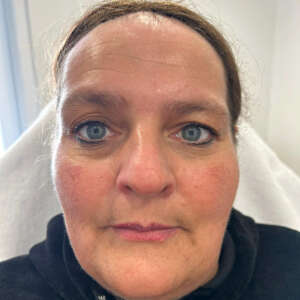 Full Face Gesichtsconturing mit Hyaluron, Lippenunterspritzung in Kombination mit Permanent Make Up vorher