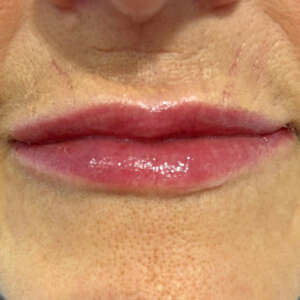 Natürlich geformte Lippen und Plisseefalten mit Hyaluron direkt nach der Behandlung