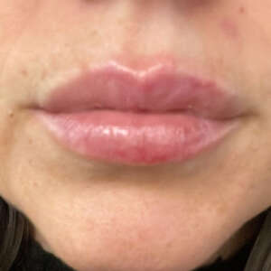 Lippencontouring mit Hyaluron natürliches Ergebnis direkt nach der Behandlung