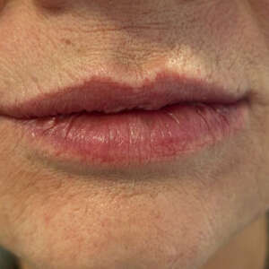 Hyaluronbehandlung Lippen direkt nach der Behandlung
